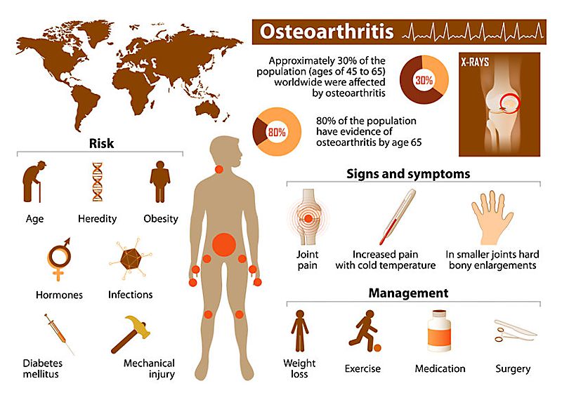 osteoarthritis infographic